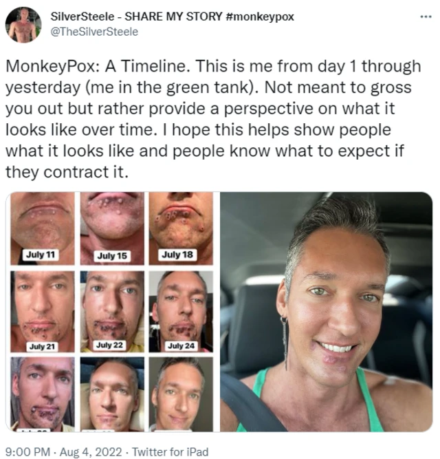 실버 스틸이 자신의 트위터에 공유한 원숭이두창 투병 기록