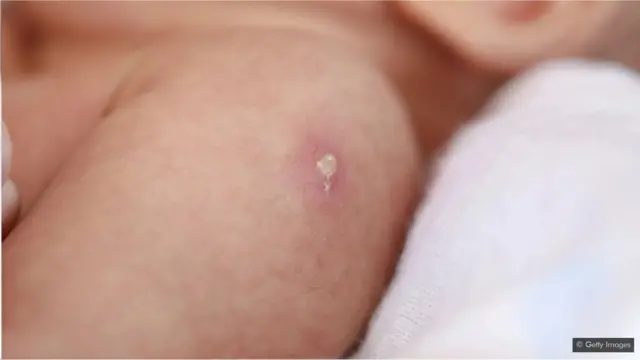 卡介苗被认为重新编程了免疫系统的DNA。