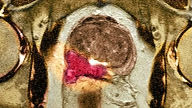 پروستات سرطان