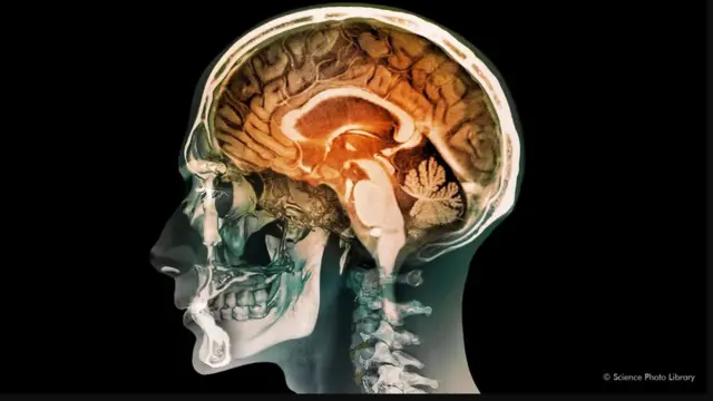 ስእሊ ሓንጎል