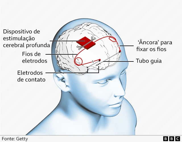 Gráfico mostrando como funciona o implante cerebral