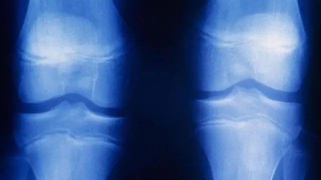 eklem röntgeni