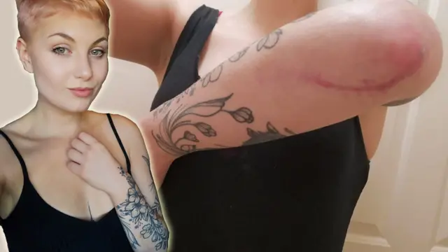 교통사고로 생긴 팔 상처 주변에 무신을 한 맥신