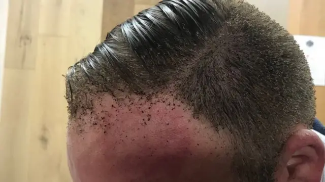 پیتر یکی از مسافرانی است که بخشی از پیشانی و موهایش سوخته است