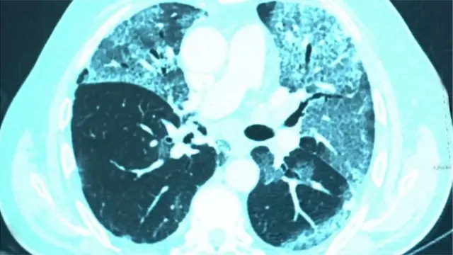 কোভিড আক্রান্ত হবার পর ক্ষতিগ্রস্ত ফুসফুসের ছবি