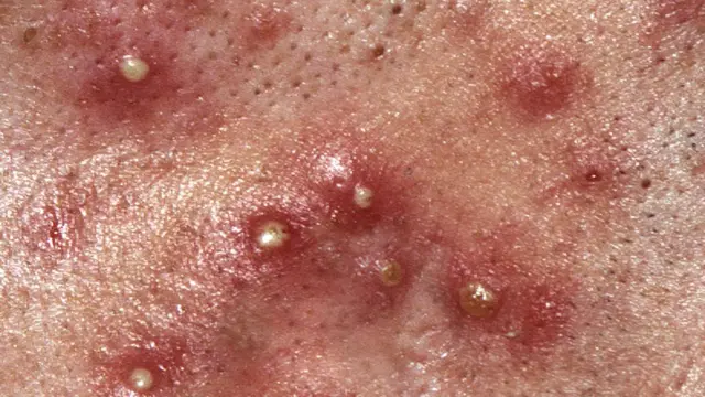 L'acné est une maladie inflammatoire de la peau caractérisée par des lésions des follicules pilo-sébacés.