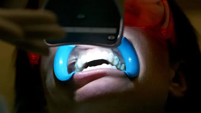 Perawatan pemutihan gigi secara profesional