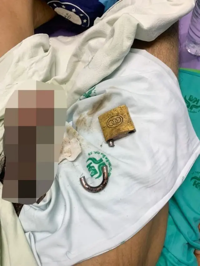 Ọkunrin naa lẹyin ti wọn ge agadagodo kuro lara rẹ̀