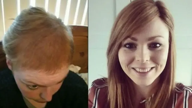 ট্রিকোটিলোম্যানিয়ায় আক্রান্ত একজন