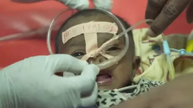 "දොස්තර මහත්තුරු හරියට මහන්සි වුනා. ඔක්සිජන් දුන්න.., බට දාල කෑම දුන්න..., ඊට පස්සේ මේ බෝතලේට වතුර පුරවල බට දාල දරුවගෙ නහයට හයිකළා...."