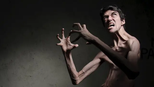 marfan nude  Orthopaedic Aspects of Marfan Syndrome: The Experience of a Referral Center  for Diagnosis of Rare Diseases - De Maio - 2016 - Advances in Orthopedics -  Wiley Online Library