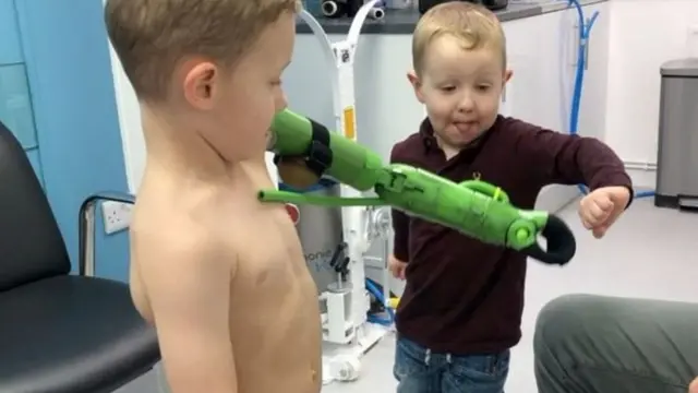 джейкоб, протез руки