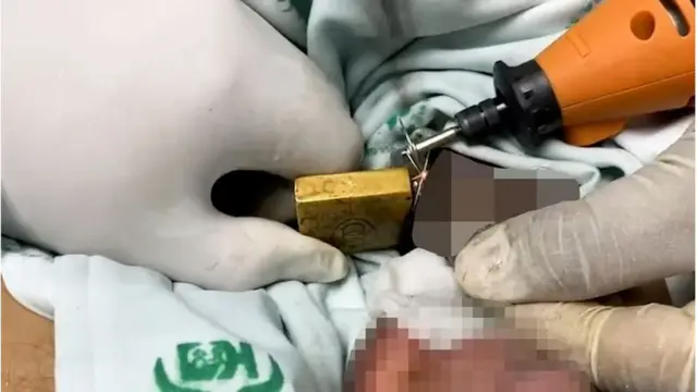 Ọkunrin naa lasiko ti awọn dokita n ge irin agadagodo