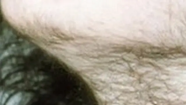 A woman with excessive hair problem.