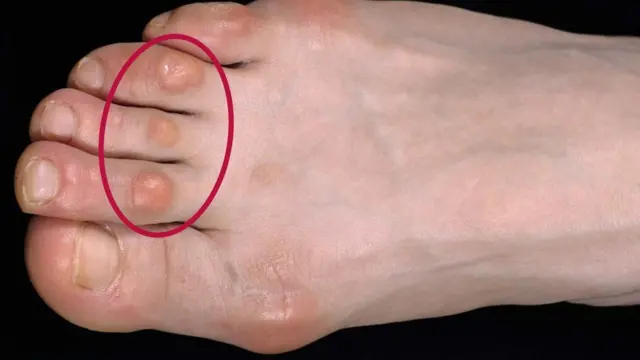 Ụkwụ onye nwere "corn"