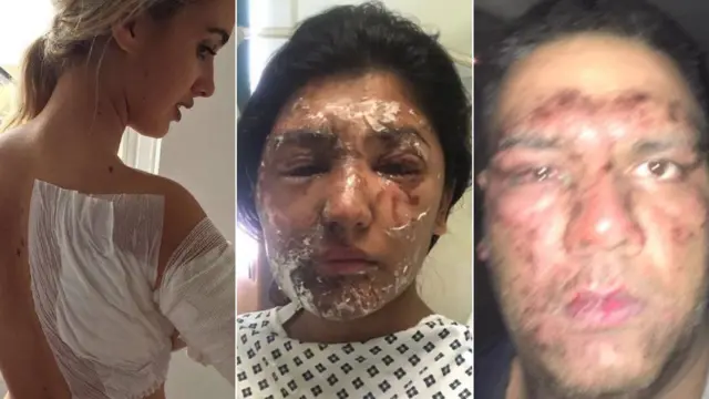 من ضحايا هجمات في استخدام الحمض الكاوي في لندن هذا العام