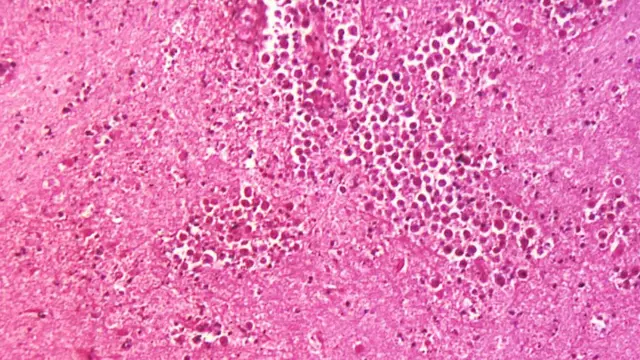 Мозговая ткань, пораженная инфекцией