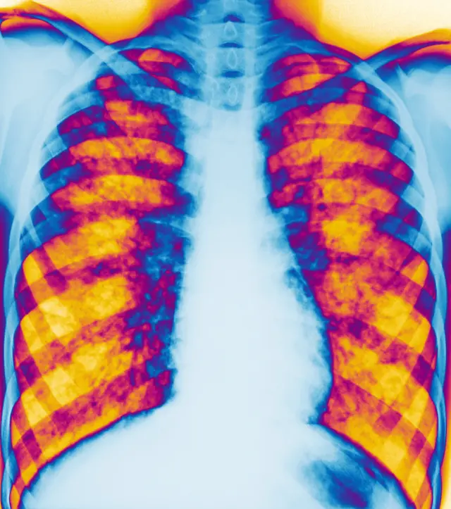 Rendgenski snimak pluća pacijenta sa cističnom fibrozom
