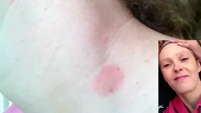 Slika ujeda, slika Rejčel Folks-Dejvis pre incidenta