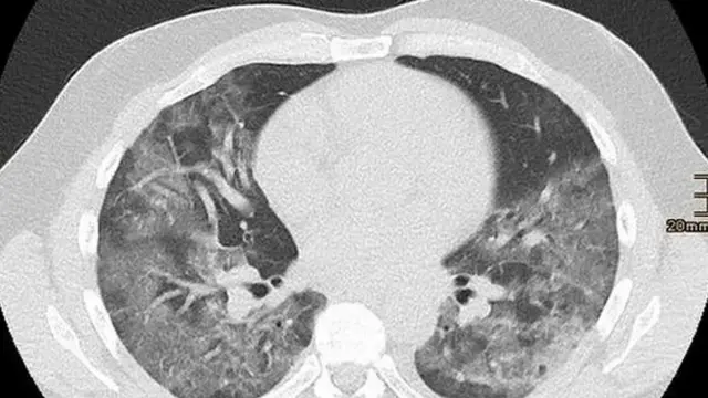 CT Scan menunjukkan pasien tanpa gejala mengalami kerusakan paru-paru.
