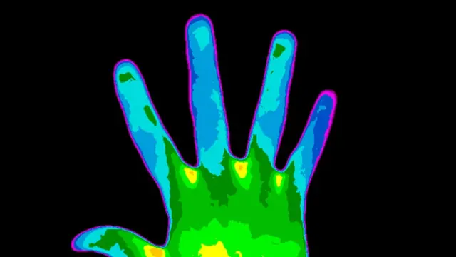 mano de una persona con esclerosis múltiple