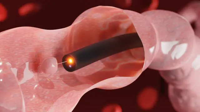 கலோனோஸ்கோபி