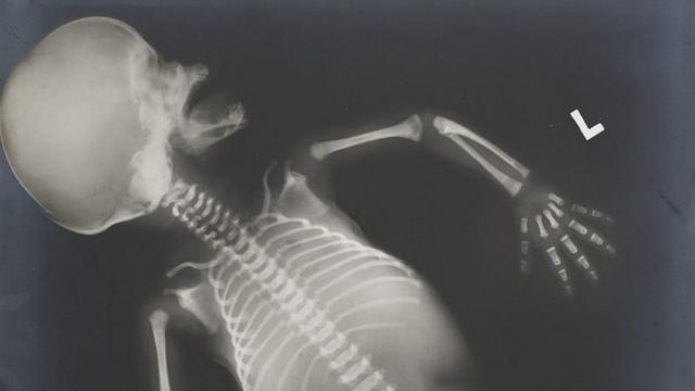 Radiographie fœtale d'un bébé de sexe masculin