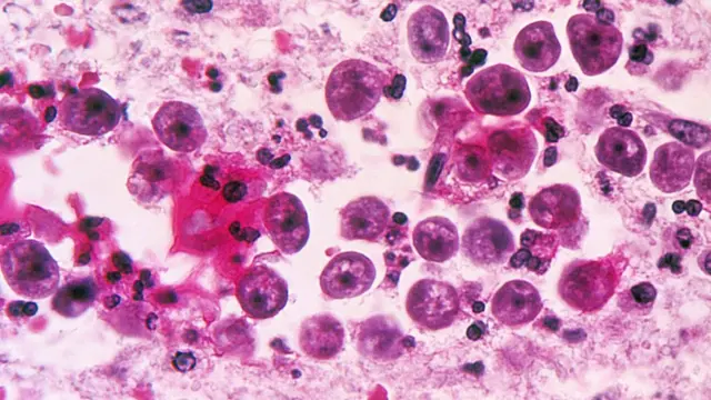 A microscopic image of a Naegleria fowleri amoeba infection