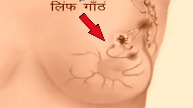 स्तन कैंसर