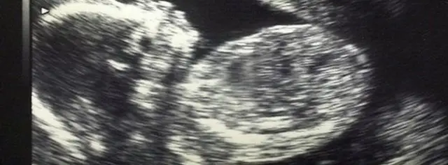 प्रेग्नेंसी, ट्रांसप्लांट