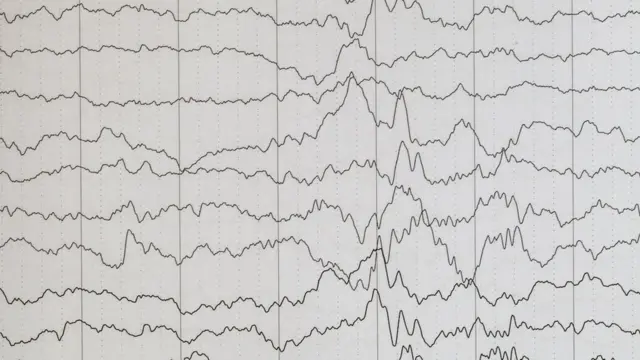 Encefalograma mostra traçosaumento de aposta bet365epilepsia