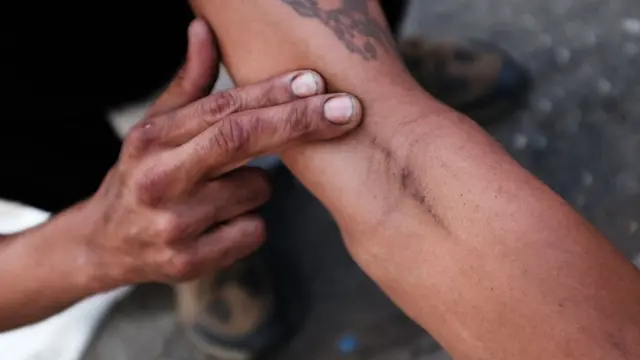 Brazo de una persona con marcas de los pinchazos