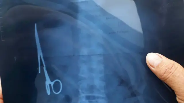 عکس از شکم بیمار