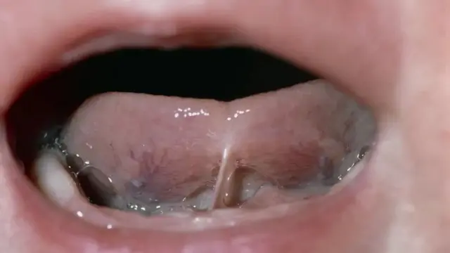 நாக்கு இயக்க குறைபாடு