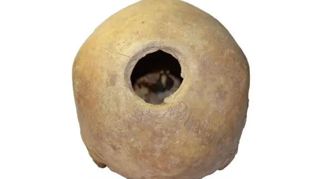 جمجمه سوراخ شده یک زن بین ۲۰ تا ۲۵ ساله. تنها بخشی از سوراخ ترمیم یافته