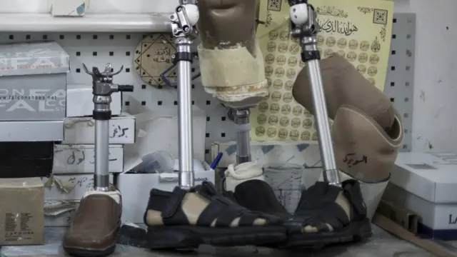 Металлические протезы в Центре протезирования конечностей в Газе