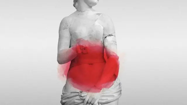 Ендометріоз