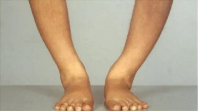 व्हिटॅमिन डी