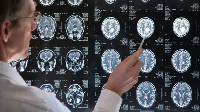 La tumeur cérébrale de Sarah a perturbé les neurones impliqués dans le traitement du son