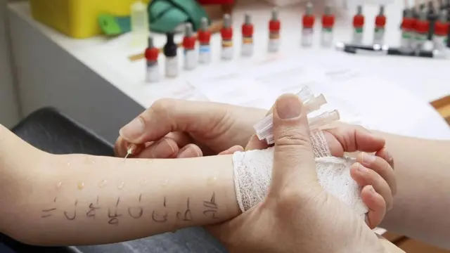 Харчова алергія