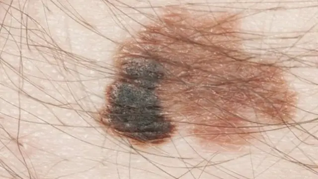 ত্বকের ক্যান্সারের চিকিৎসাতেও ভাইরাল থেরাপি ব্যবহার করা হয়।