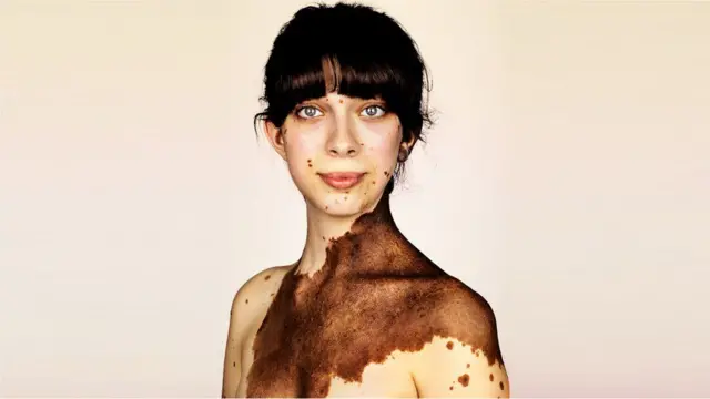 Las imgenes que muestran el nevus melanoctico, la extraa condicin por  la que salen enormes manchas de nacimiento - BBC News Mundo
