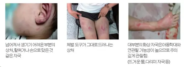 <아동학대 신고 의무자가 알아야 할 아동학대 예방요령>에 나와있는 신체 학대 정황
