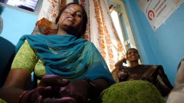 एसिड हमले की पीड़िता