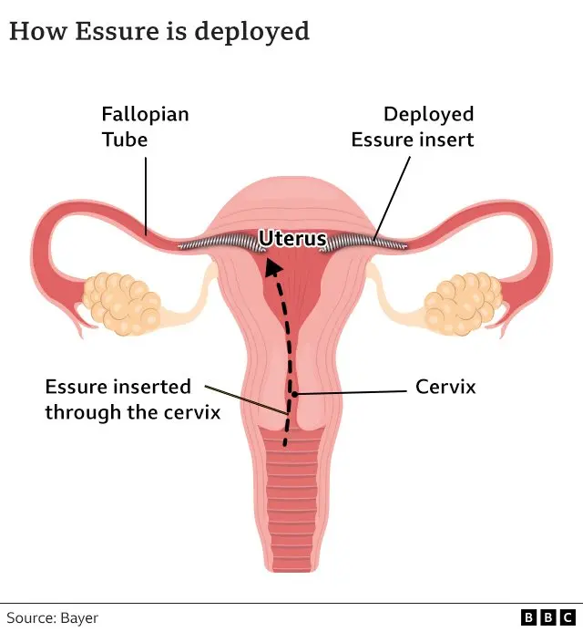 Bagaimana Essure diterapkan.