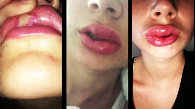 Images de blessures subies lors du blanchiment des dents