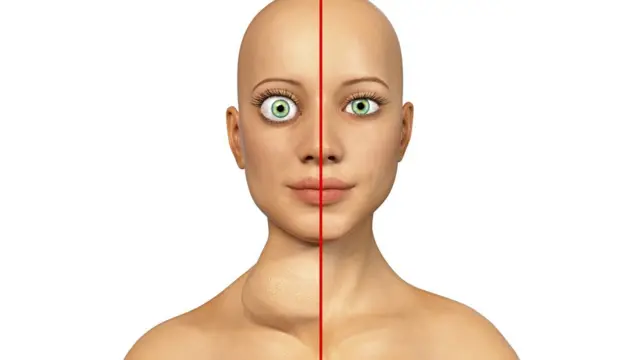 গ্রেভস ডিজিজ