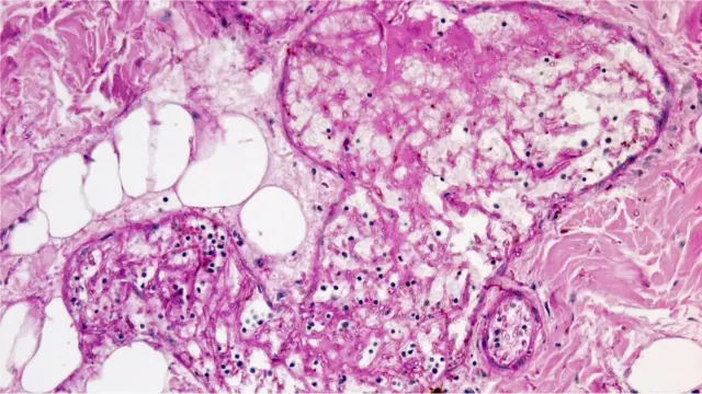 میوکورمائیکوسز