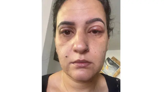 Selfie de Valéria Campos con los ojos inchados.