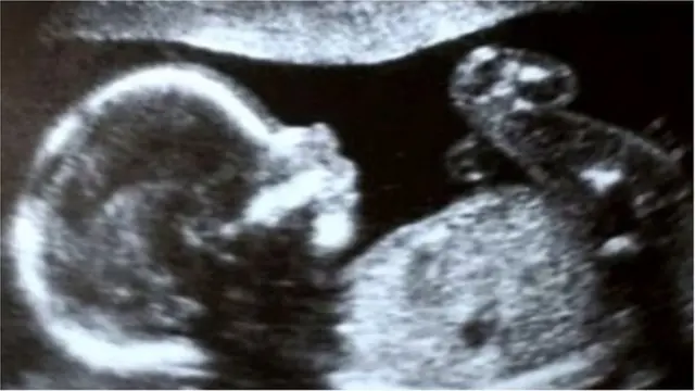 గర్భాశయ మార్పిడి